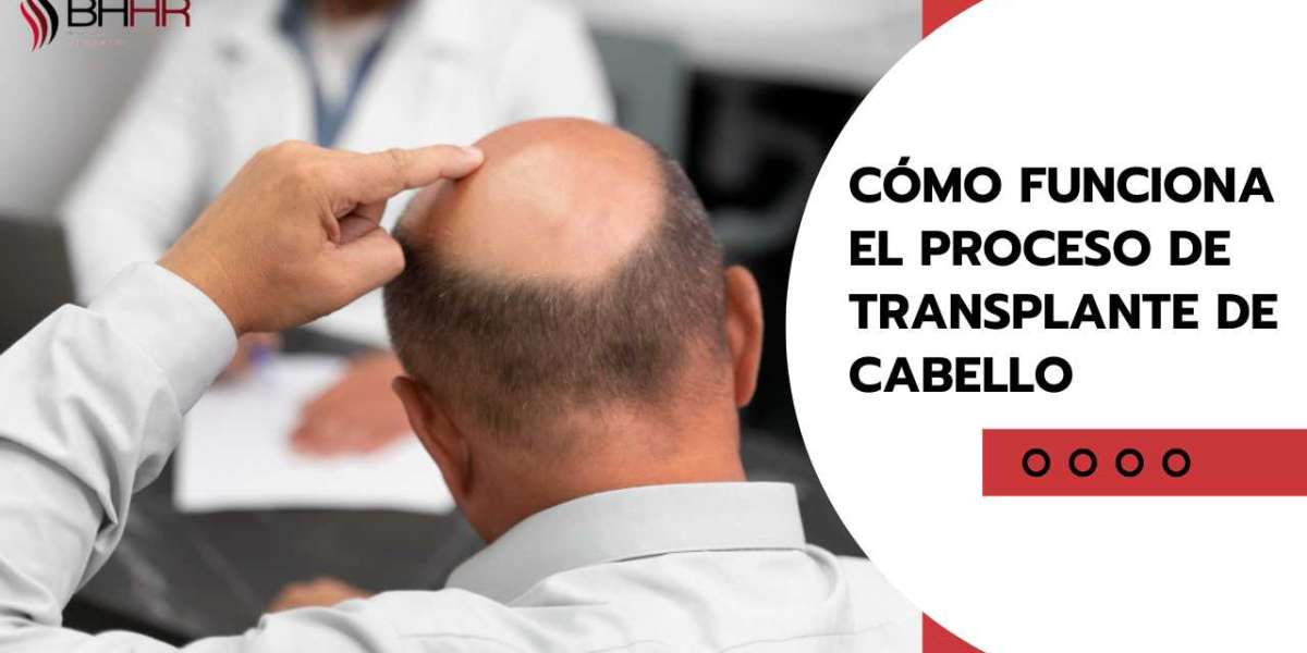 Cómo funciona el proceso de transplante de cabello