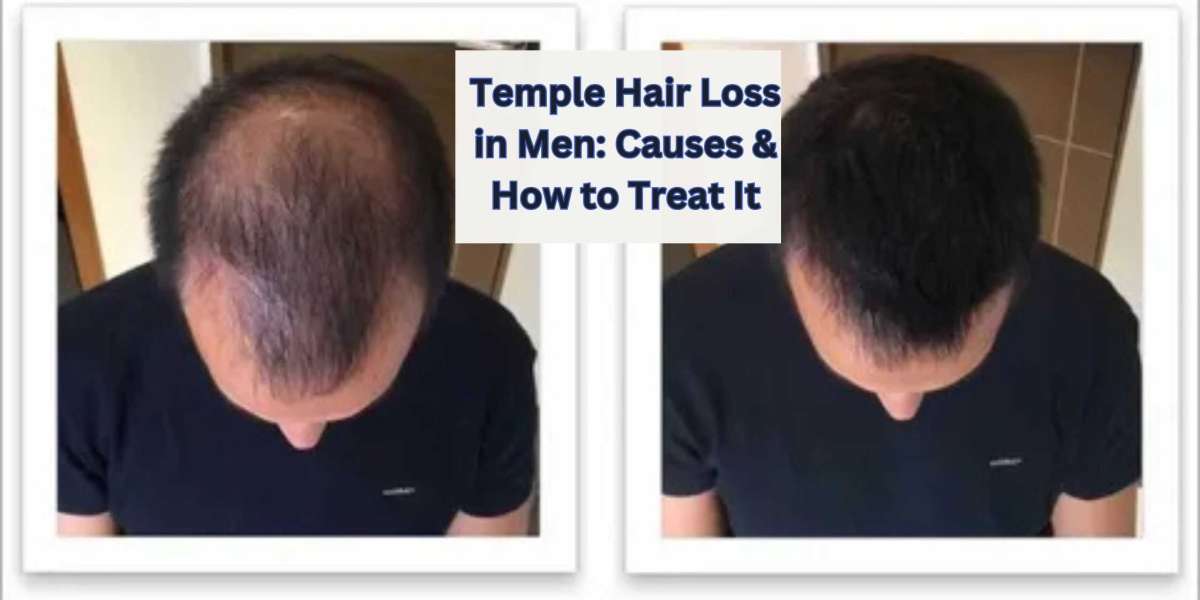 Temple Hair Loss: Causes & How to Treat It