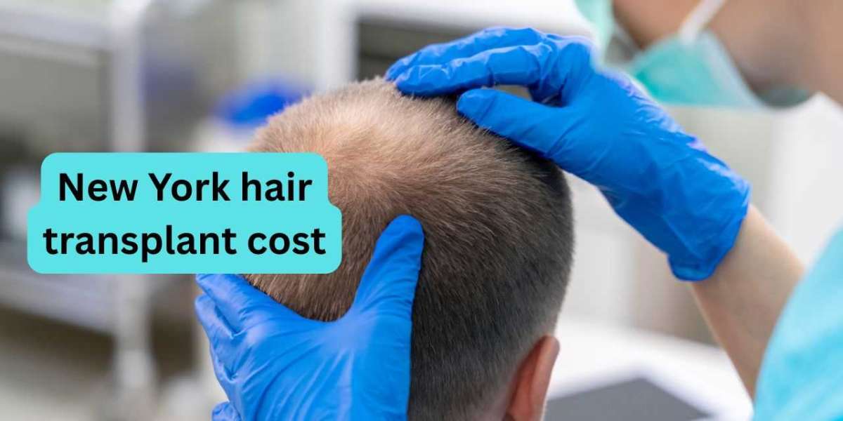 Affordable New York Hair Transplant Cost Guide