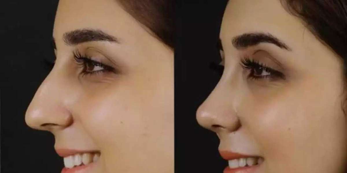 Why ENT Specialists Recommend Nose Deviated Septum Surgery in Dubai