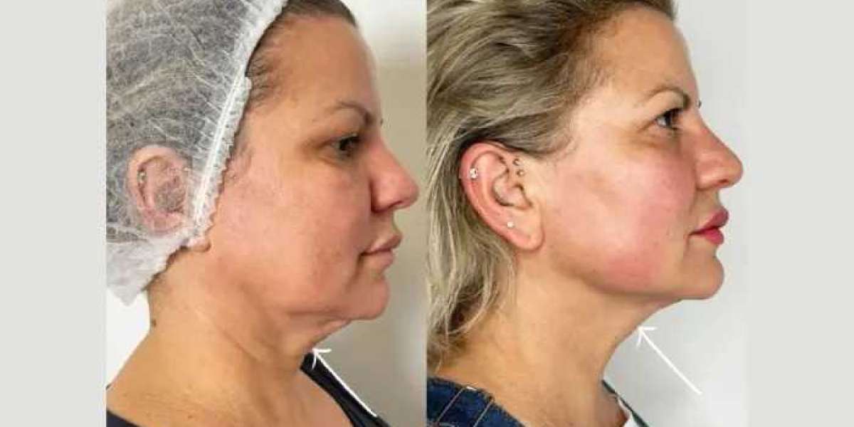 My Top Recommendation: Endolift with the Best Doctors in Dubai