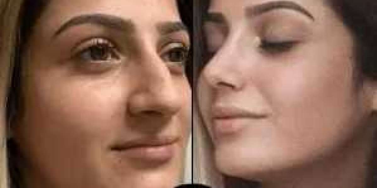 Best Plastic Surgeon in Dubai for Mommy Makeovers
