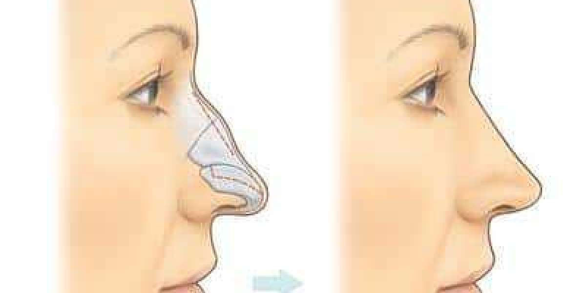 Common Myths About Rhinoplasty in Islamabad