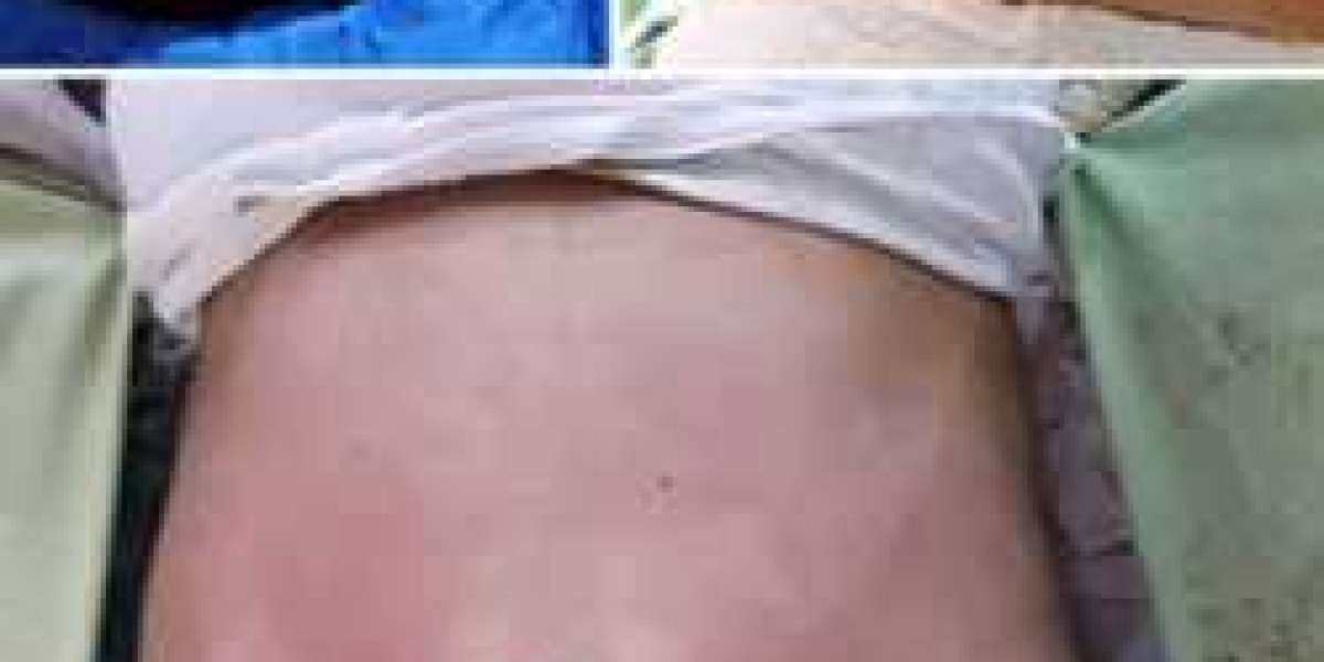 Is the Low Liposuction Cost in Pakistan Too Good to Be True?