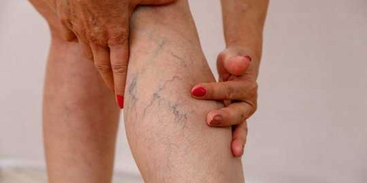 Consult a Varicose Veins Doctor in India – Safe & Effective Solutions