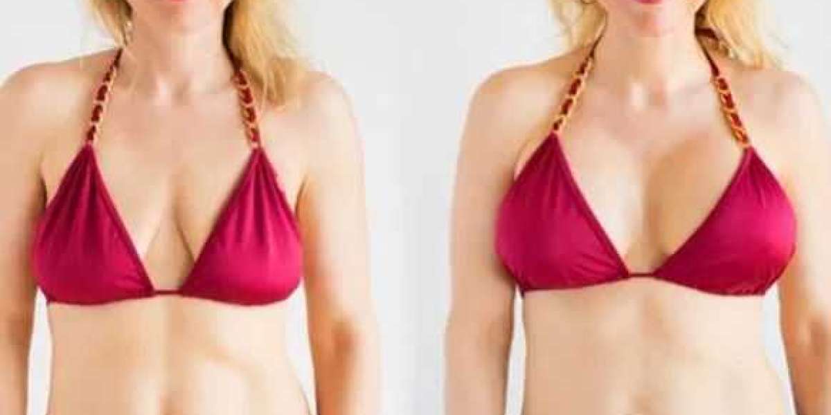 Breast Reduction in Bangalore – Restore Comfort & Confidence at Aesthetic International
