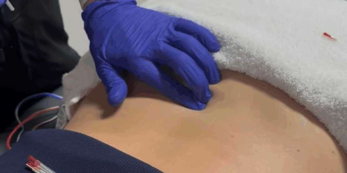 Dry Needling: A Complete Guide to Pain Relief and Recovery at Flexology Studios