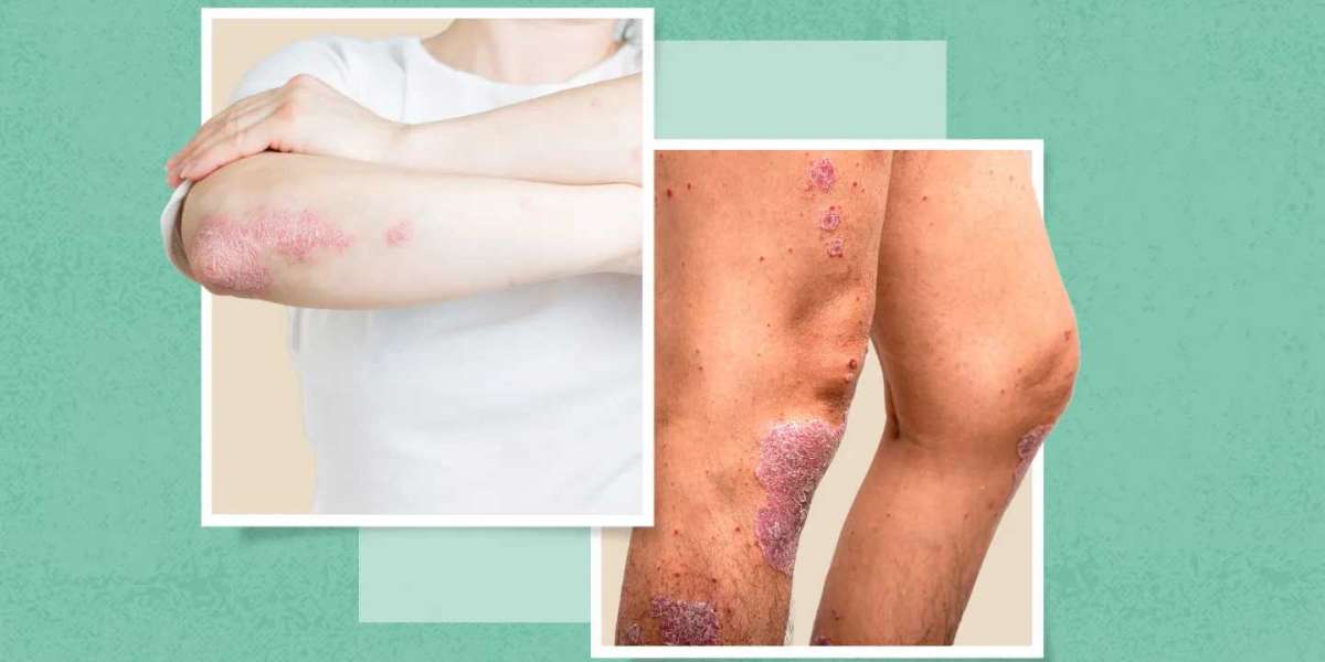 Psoriasis: Causes, Symptoms, Triggers, and Effective Treatment Options