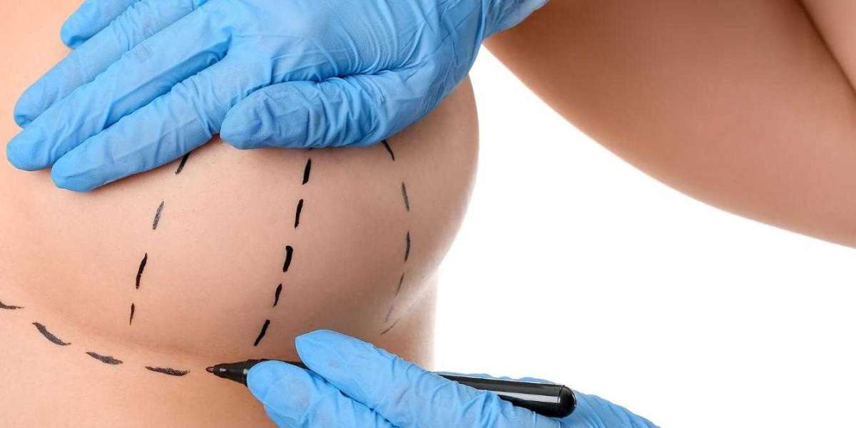 Breast Reduction Surgery in Delhi by the Best Plastic Surgeon in Delhi | Handa Plastic Surgery